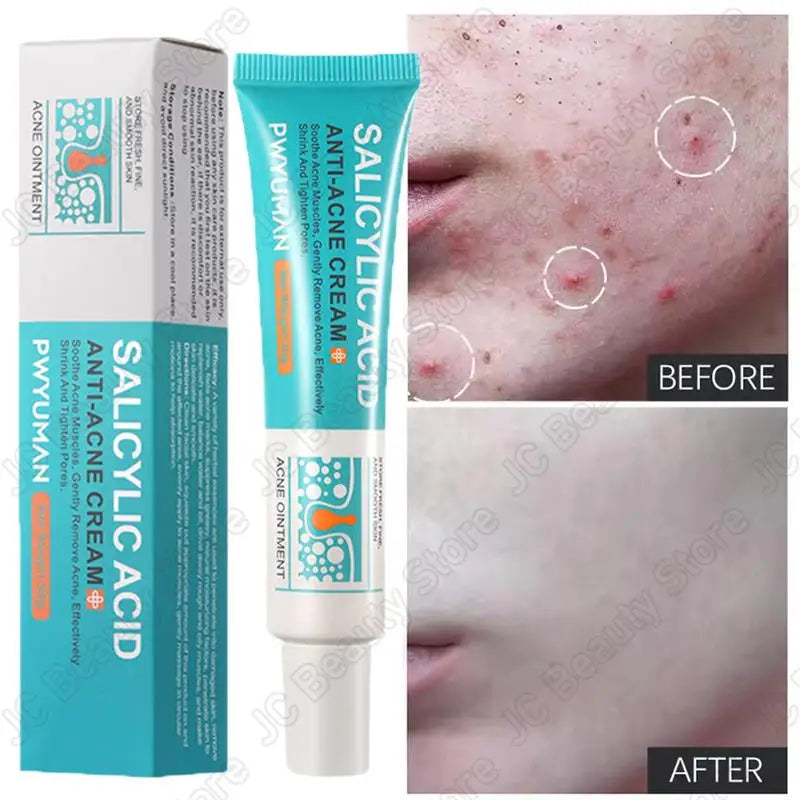Salicylic Acid Acne Treatment Face Cream Repair Pimple Spots Deep Cleaning Pore Anti-acne Scar Oil Control Moisturizer Skin Care