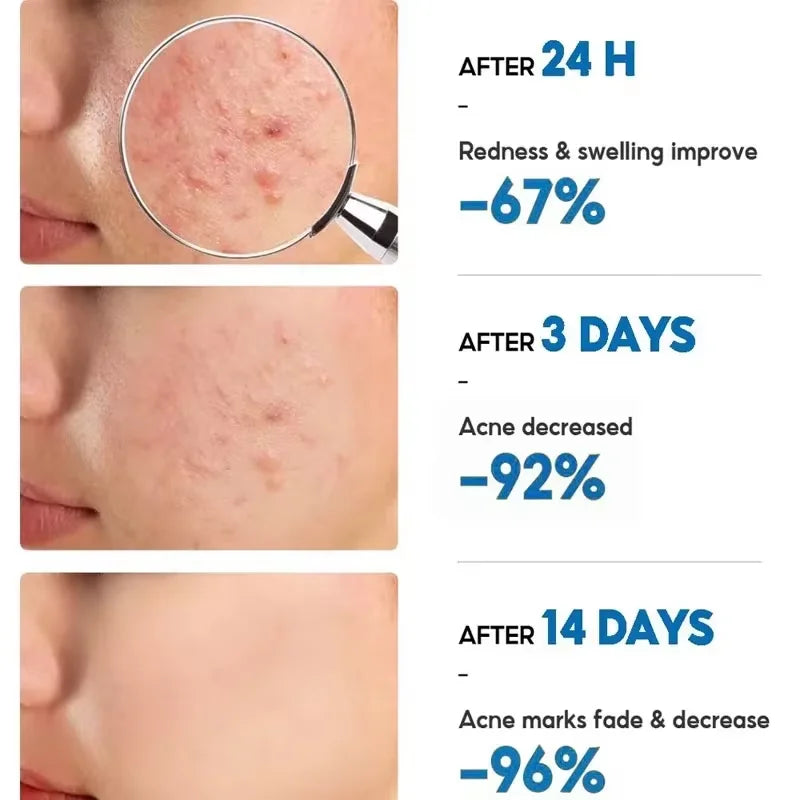 Salicylic Acid Acne Treatment Face Cream Repair Pimple Spots Deep Cleaning Pore Anti-acne Scar Oil Control Moisturizer Skin Care