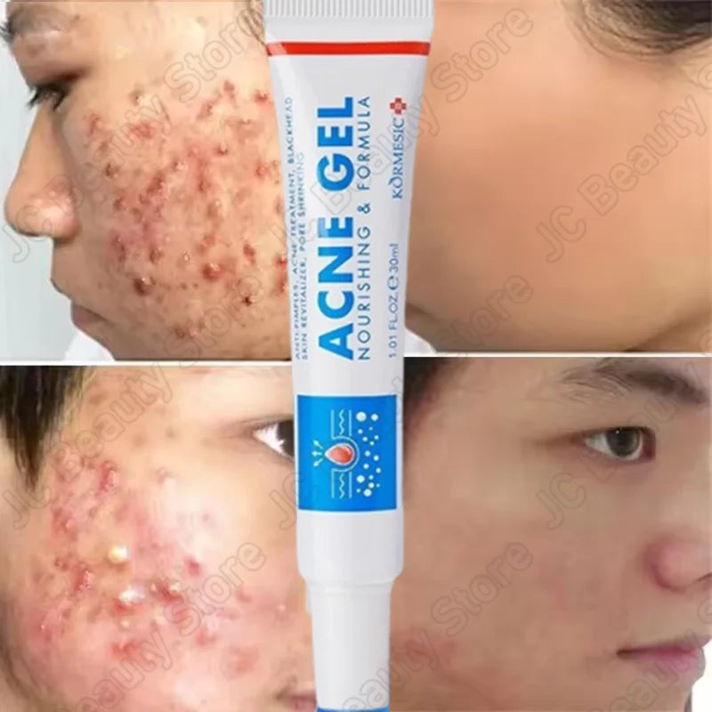 Salicylic Acid Acne Treatment Face Cream Repair Pimple Spots Deep Cleaning Pore Anti-acne Scar Oil Control Moisturizer Skin Care