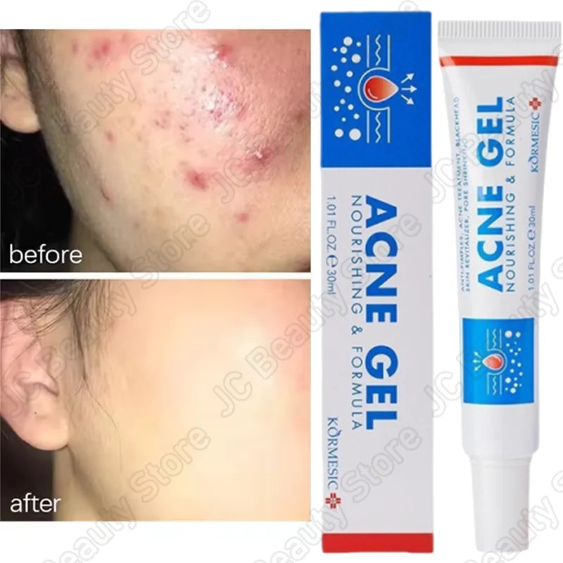 Salicylic Acid Acne Treatment Face Cream Repair Pimple Spots Deep Cleaning Pore Anti-acne Scar Oil Control Moisturizer Skin Care