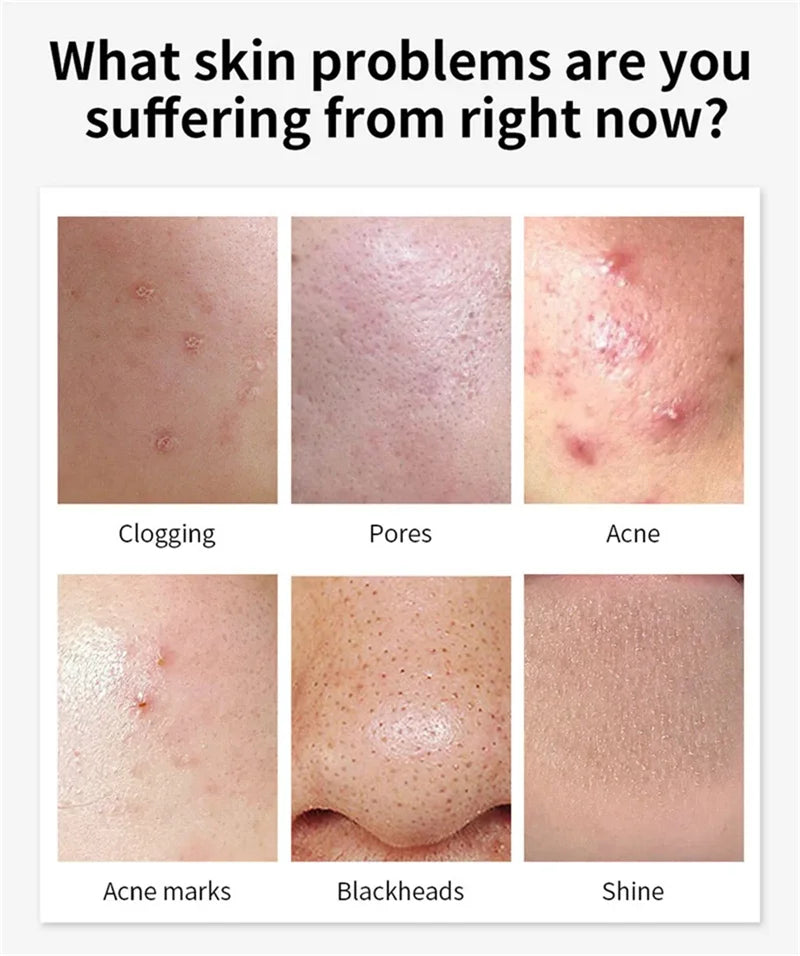 Salicylic Acid Acne Treatment Face Cream Repair Pimple Spots Deep Cleaning Pore Anti-acne Scar Oil Control Moisturizer Skin Care